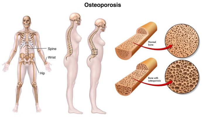 osteoporosis